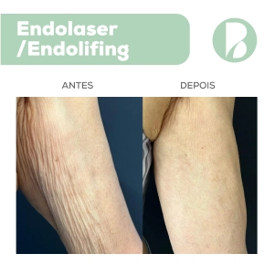 endolifting - Exemplo 2